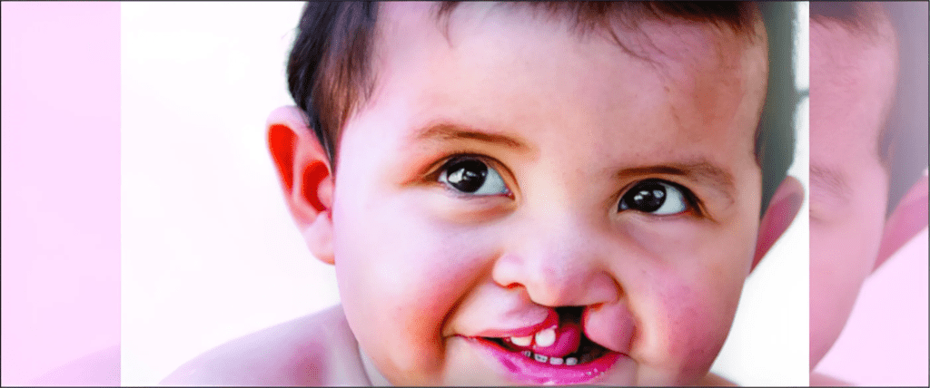 Cleft Lip